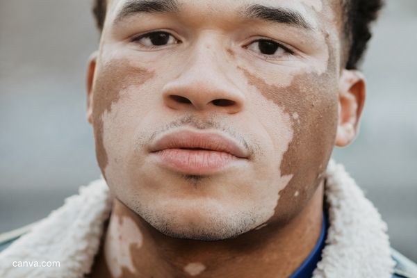 Penyakit vitiligo atau hidung belang